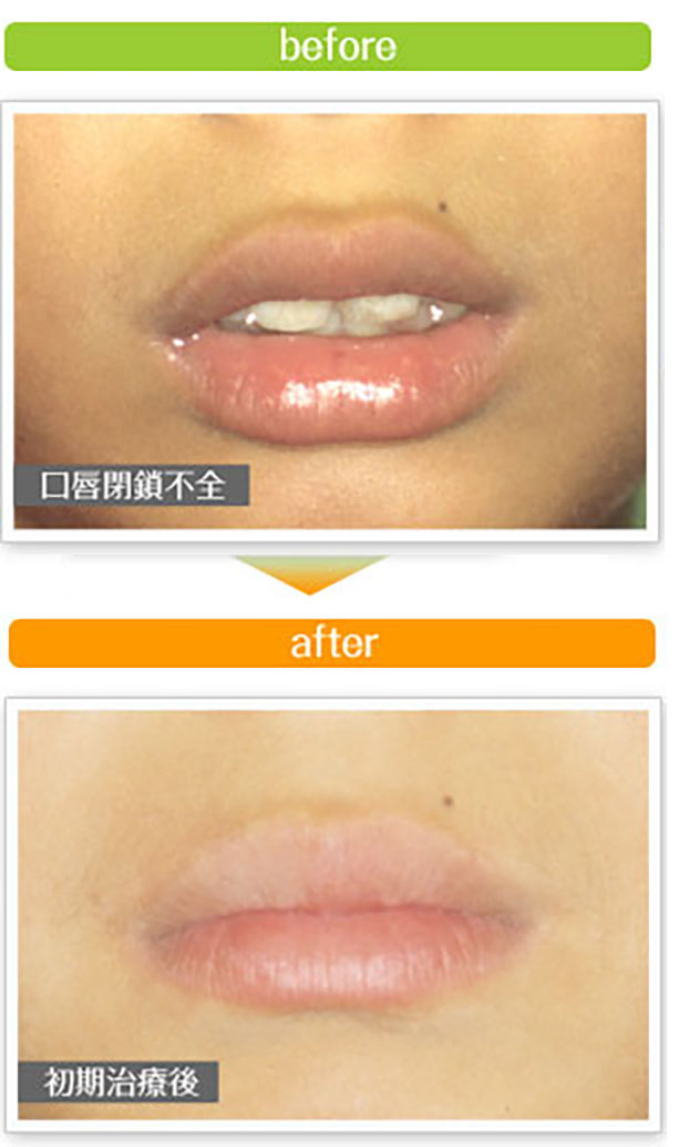 治療後、口が自然と閉じられるようになりました